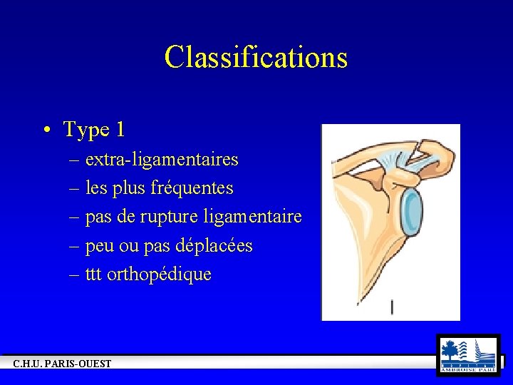 Classifications • Type 1 – extra-ligamentaires – les plus fréquentes – pas de rupture