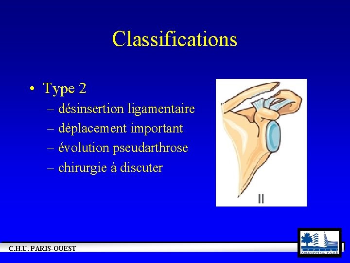 Classifications • Type 2 – désinsertion ligamentaire – déplacement important – évolution pseudarthrose –