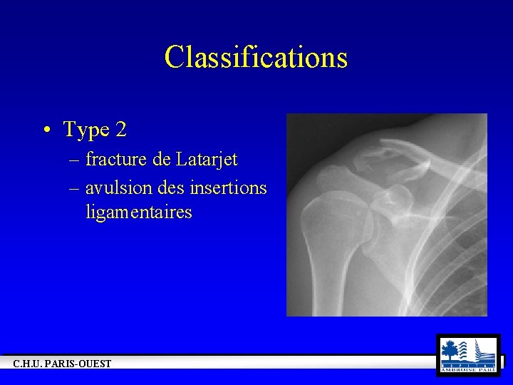 Classifications • Type 2 – fracture de Latarjet – avulsion des insertions ligamentaires C.