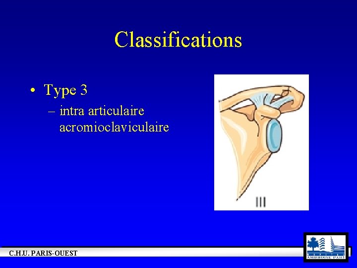 Classifications • Type 3 – intra articulaire acromioclaviculaire C. H. U. PARIS-OUEST 