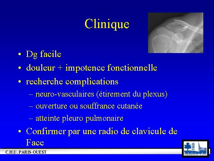 Clinique • Dg facile • douleur + impotence fonctionnelle • recherche complications – neuro-vasculaires