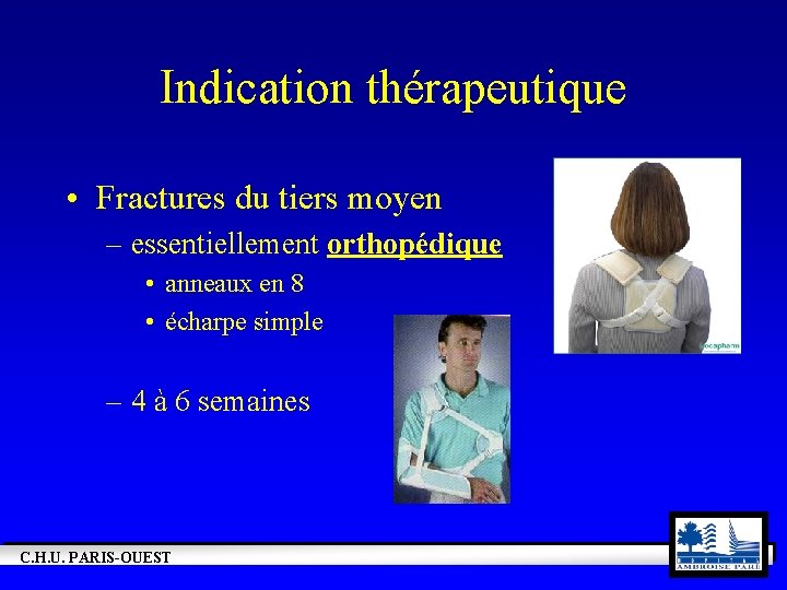 Indication thérapeutique • Fractures du tiers moyen – essentiellement orthopédique • anneaux en 8