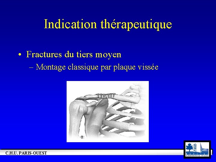 Indication thérapeutique • Fractures du tiers moyen – Montage classique par plaque vissée C.