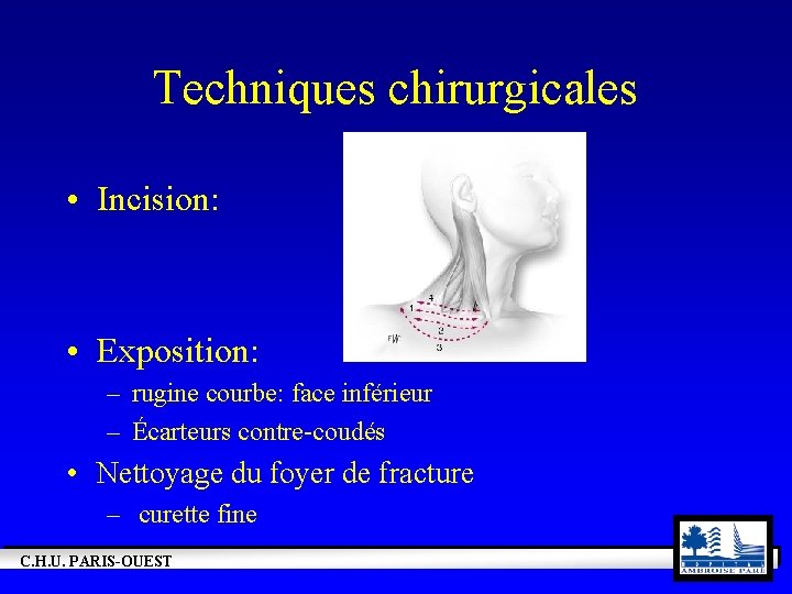 Techniques chirurgicales • Incision: • Exposition: – rugine courbe: face inférieur – Écarteurs contre-coudés