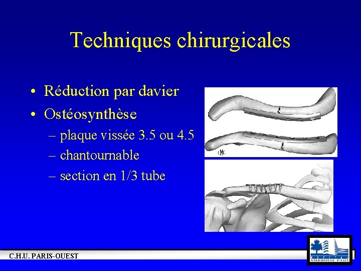 Techniques chirurgicales • Réduction par davier • Ostéosynthèse – plaque vissée 3. 5 ou