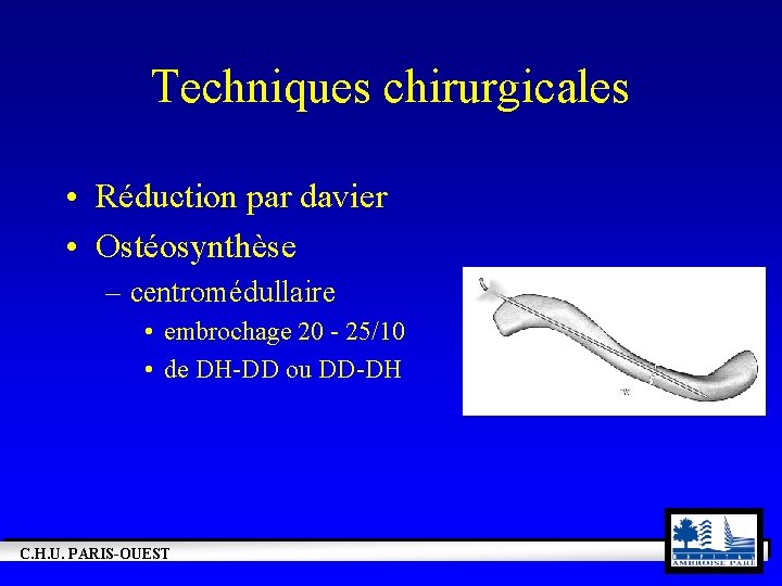Techniques chirurgicales • Réduction par davier • Ostéosynthèse – centromédullaire • embrochage 20 -