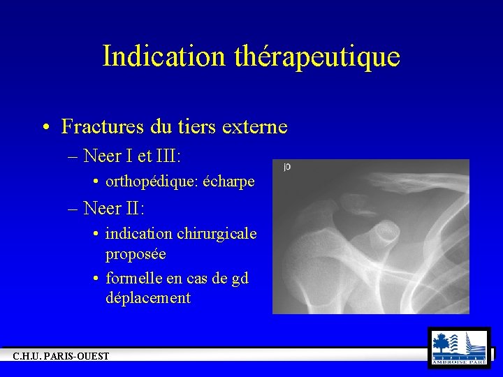 Indication thérapeutique • Fractures du tiers externe – Neer I et III: • orthopédique: