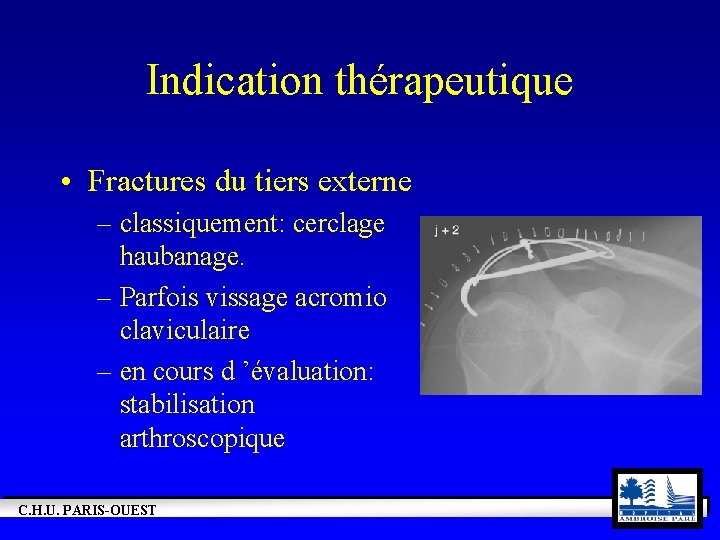 Indication thérapeutique • Fractures du tiers externe – classiquement: cerclage haubanage. – Parfois vissage