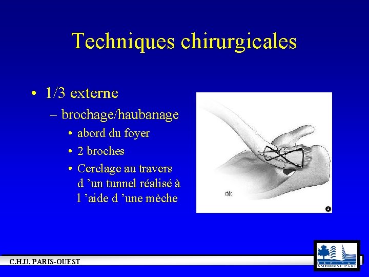 Techniques chirurgicales • 1/3 externe – brochage/haubanage • abord du foyer • 2 broches