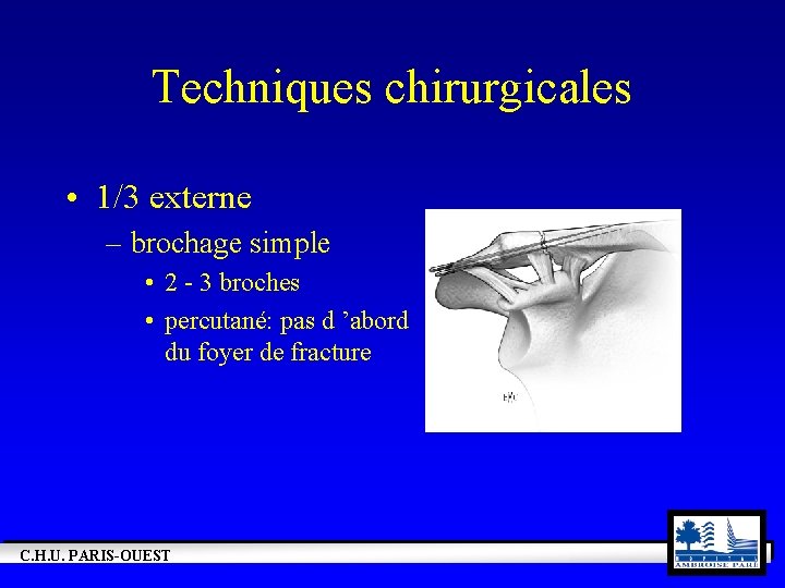 Techniques chirurgicales • 1/3 externe – brochage simple • 2 - 3 broches •
