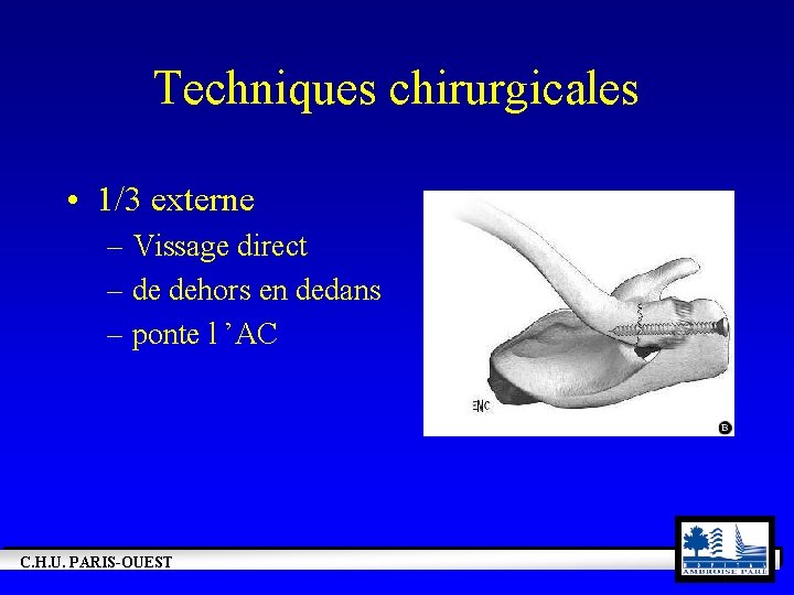 Techniques chirurgicales • 1/3 externe – Vissage direct – de dehors en dedans –