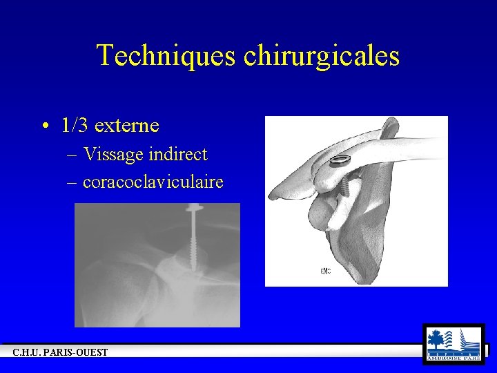 Techniques chirurgicales • 1/3 externe – Vissage indirect – coracoclaviculaire C. H. U. PARIS-OUEST