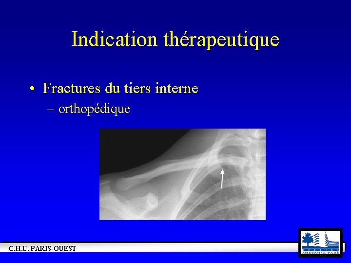 Indication thérapeutique • Fractures du tiers interne – orthopédique C. H. U. PARIS-OUEST 