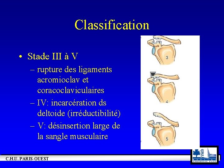 Classification • Stade III à V – rupture des ligaments acromioclav et coracoclaviculaires –