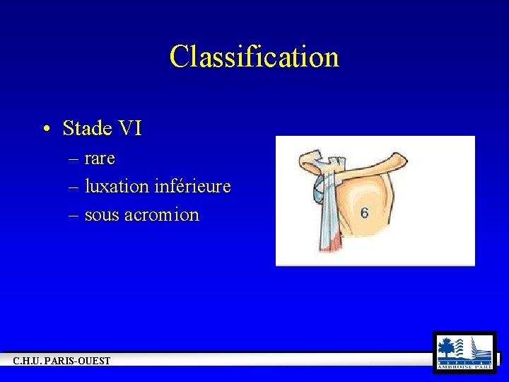 Classification • Stade VI – rare – luxation inférieure – sous acromion C. H.