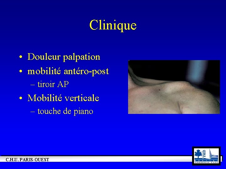 Clinique • Douleur palpation • mobilité antéro-post – tiroir AP • Mobilité verticale –