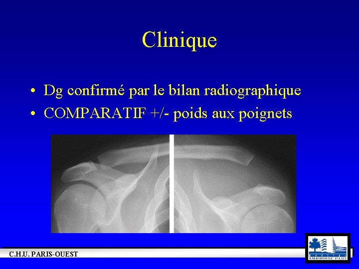 Clinique • Dg confirmé par le bilan radiographique • COMPARATIF +/- poids aux poignets