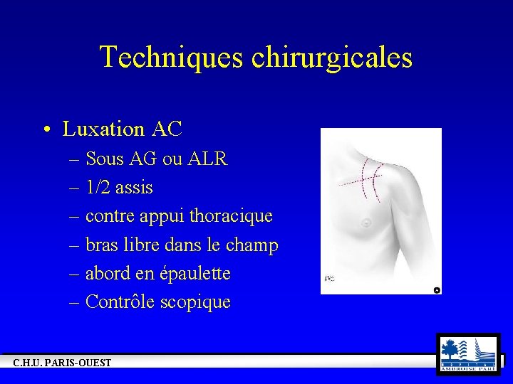 Techniques chirurgicales • Luxation AC – Sous AG ou ALR – 1/2 assis –