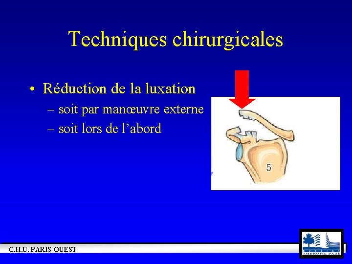 Techniques chirurgicales • Réduction de la luxation – soit par manœuvre externe – soit