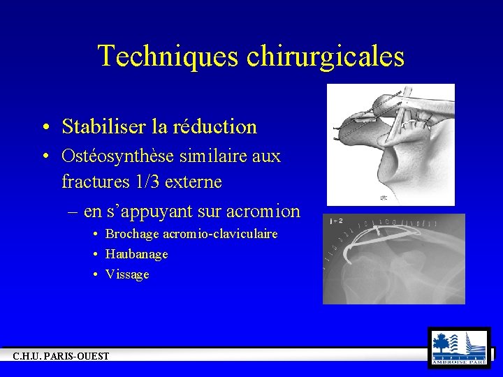 Techniques chirurgicales • Stabiliser la réduction • Ostéosynthèse similaire aux fractures 1/3 externe –
