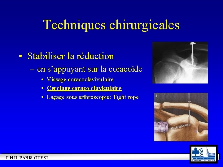 Techniques chirurgicales • Stabiliser la réduction – en s’appuyant sur la coracoïde • Vissage