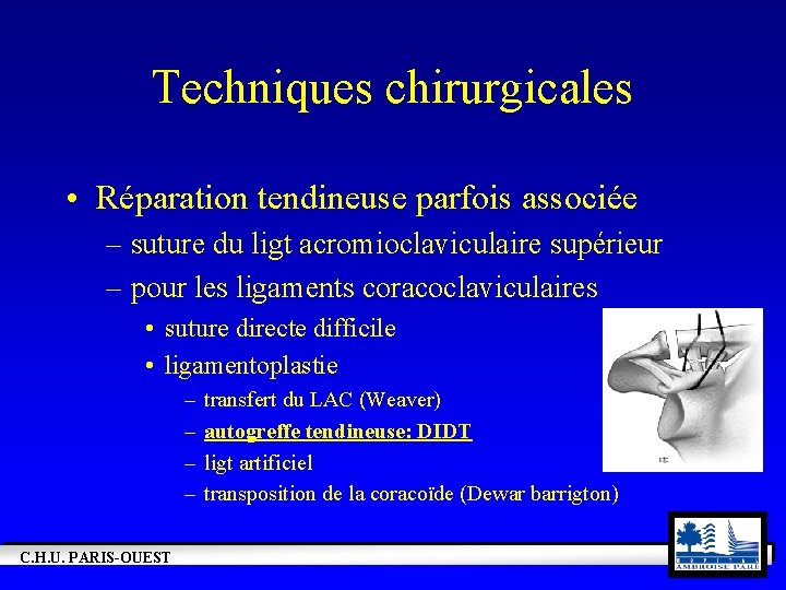 Techniques chirurgicales • Réparation tendineuse parfois associée – suture du ligt acromioclaviculaire supérieur –