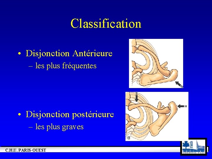 Classification • Disjonction Antérieure – les plus fréquentes • Disjonction postérieure – les plus