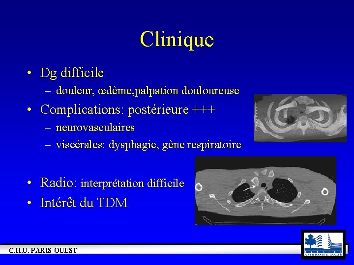 Clinique • Dg difficile – douleur, œdème, palpation douloureuse • Complications: postérieure +++ –