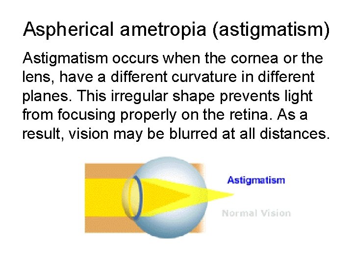 Aspherical ametropia (astigmatism) Astigmatism occurs when the cornea or the lens, have a different