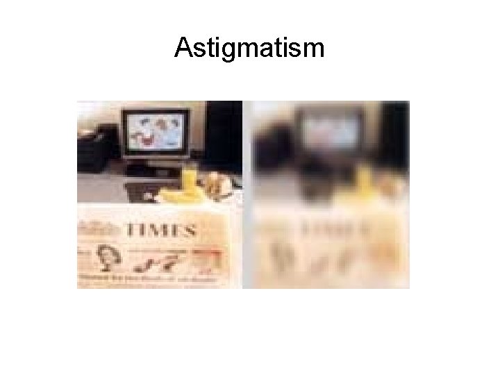 Astigmatism 