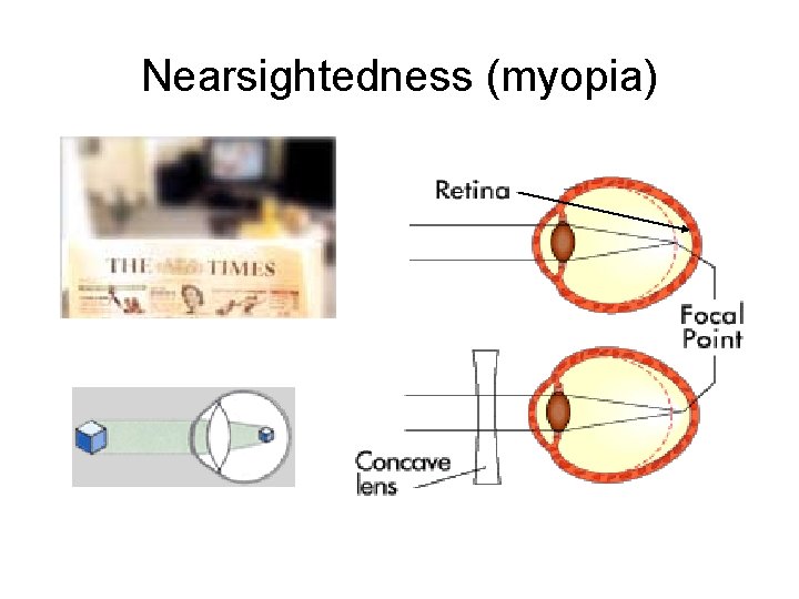 Nearsightedness (myopia) 