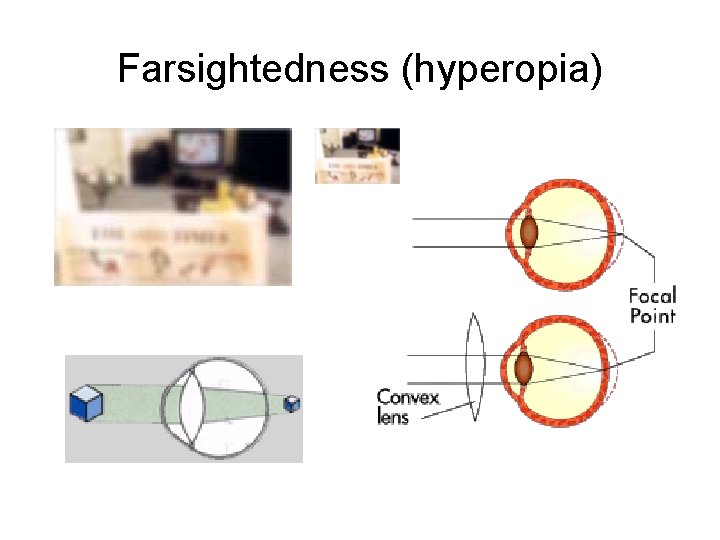 Farsightedness (hyperopia) 