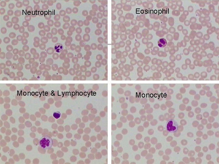 Neutrophil Monocyte & Lymphocyte Eosinophil Monocyte 