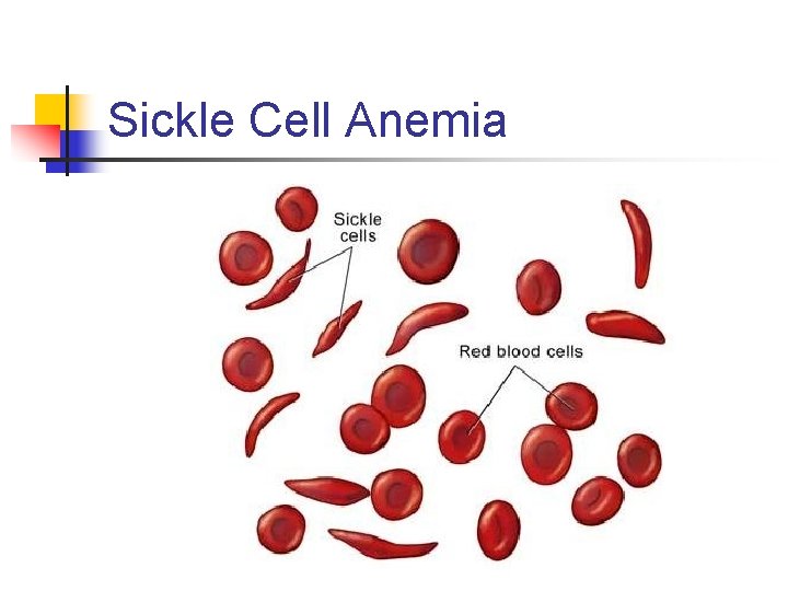Sickle Cell Anemia 