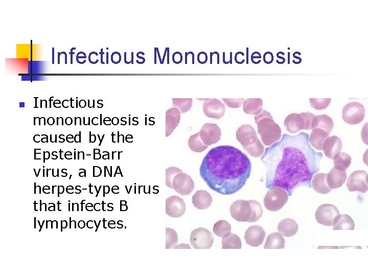 Infectious Mononucleosis n Infectious mononucleosis is caused by the Epstein-Barr virus, a DNA herpes-type