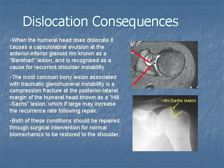 Dislocation Consequences • When the humeral head does dislocate it causes a capsulolabral avulsion