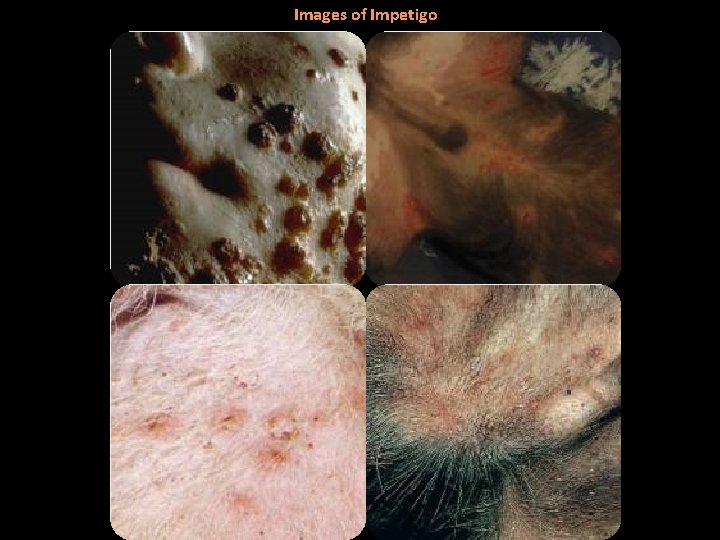 Images of Impetigo 