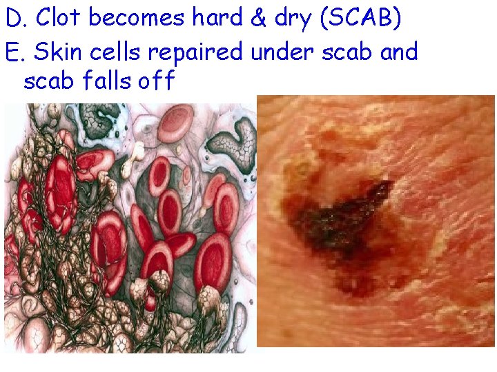 D. Clot becomes hard & dry (SCAB) E. Skin cells repaired under scab and