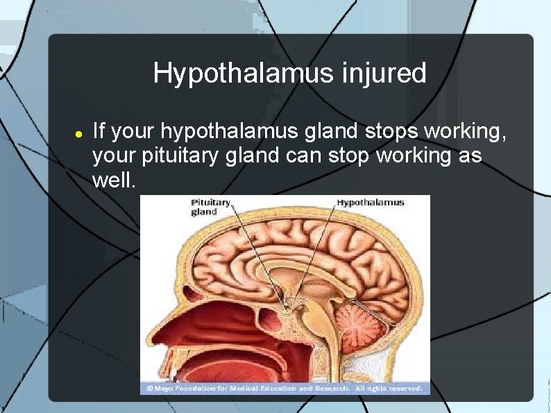 Hypothalamus injured If your hypothalamus gland stops working, your pituitary gland can stop working