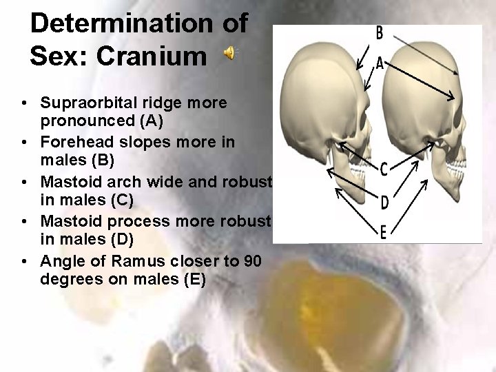 Determination of Sex: Cranium • Supraorbital ridge more pronounced (A) • Forehead slopes more