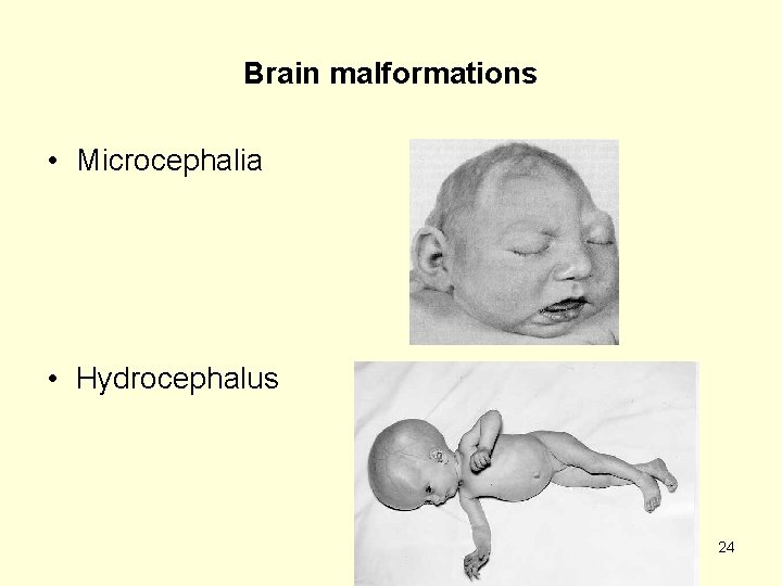 Brain malformations • Microcephalia • Hydrocephalus 24 