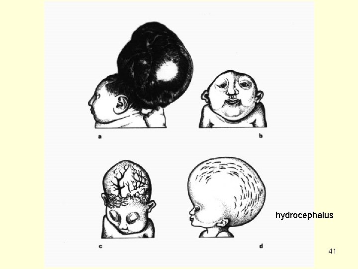 hydrocephalus 41 