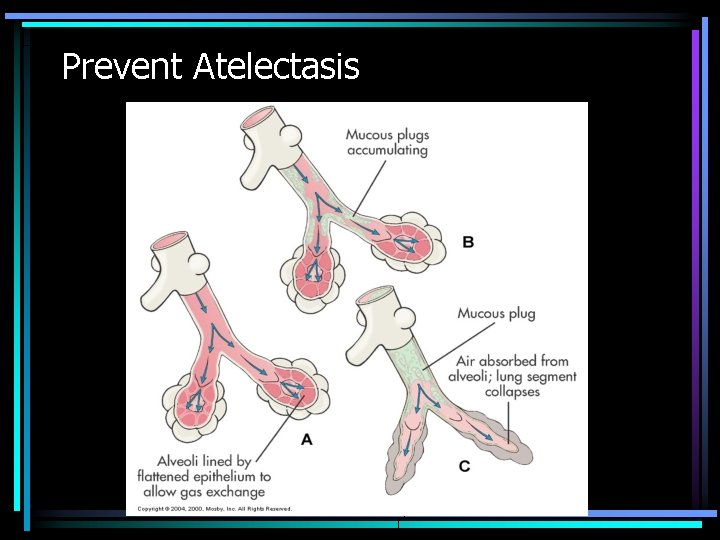 Prevent Atelectasis 