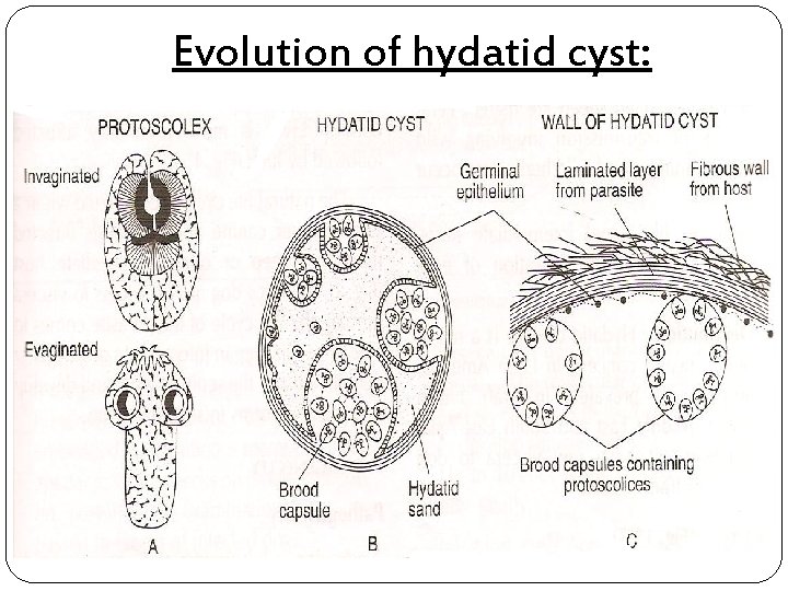 Evolution of hydatid cyst: 