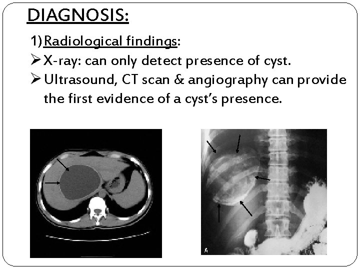 DIAGNOSIS: 1) Radiological findings: Ø X-ray: can only detect presence of cyst. Ø Ultrasound,