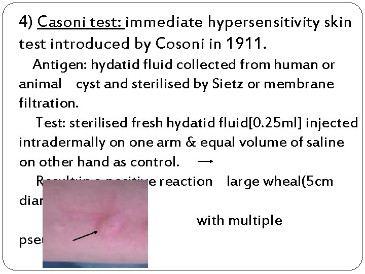 4) Casoni test: immediate hypersensitivity skin test introduced by Cosoni in 1911. Antigen: hydatid