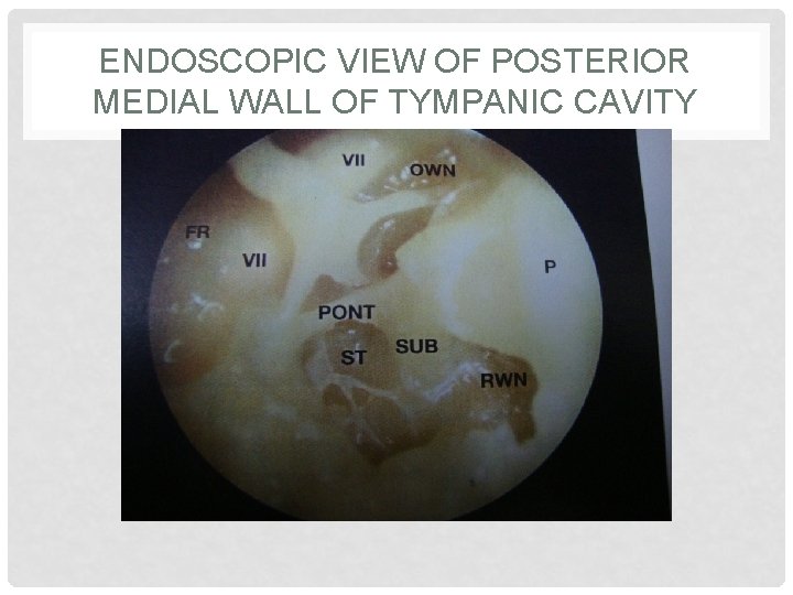 ENDOSCOPIC VIEW OF POSTERIOR MEDIAL WALL OF TYMPANIC CAVITY 