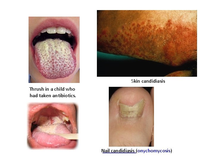 Skin candidiasis Thrush in a child who had taken antibiotics. Nail candidiasis (onychomycosis) 