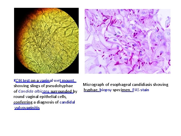 KOH test on a vaginal wet mount, Micrograph of esophageal candidiasis showing slings of