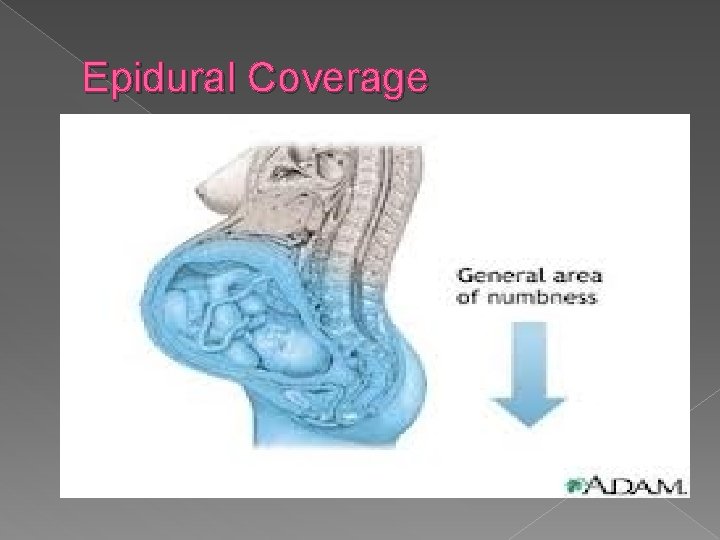 Epidural Coverage 
